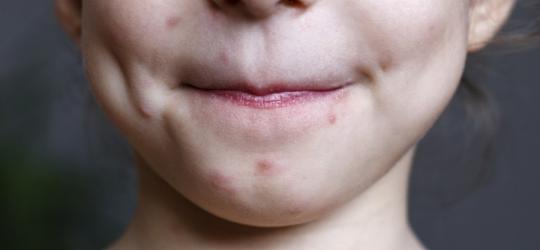 W jaki sposób objawia się ospa?