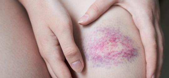 Wybroczyny na udzie kobiety.