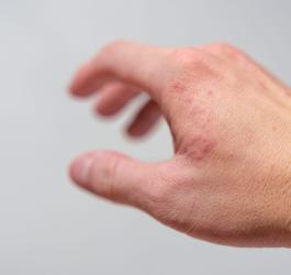 Skóra dłoni z objawami wyprysku potnicowego,