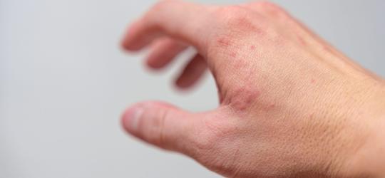 Skóra dłoni z objawami wyprysku potnicowego,