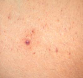 Zbliżenie na skórę z widocznym zapaleniem mieszków włosowych.