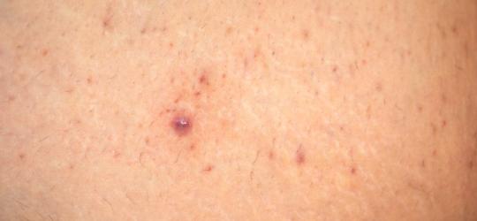 Zbliżenie na skórę z widocznym zapaleniem mieszków włosowych.