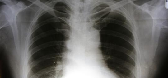 RTG klatki piersiowej w diagnostyce zatorowości płucnej.