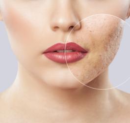 Zbliżenie na twarz kobiety z widocznymi zmianami trądzikowymi po jednej stronie twarzy.