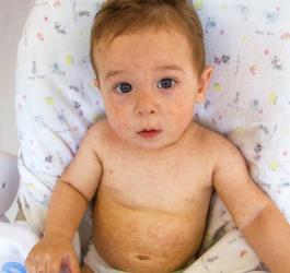 Niemowlę z wysypką na skórze.